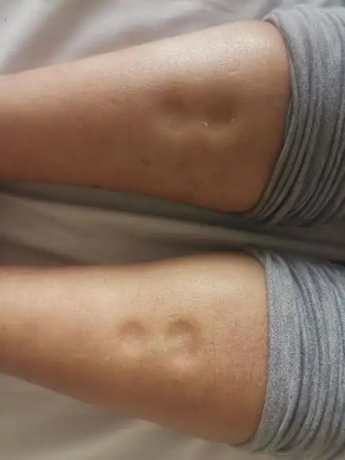 其它 肾病综合症 写美篇患者中年男性,因"双下肢水肿半月"入院.