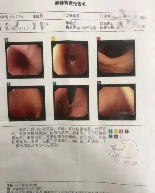 中我前后跑了多个医院,吃了好几千的药,但是诊断结果都是糜烂性胃炎