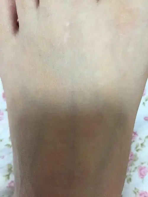 脚上白色的该不是白癜风吧?有懂的嘛?