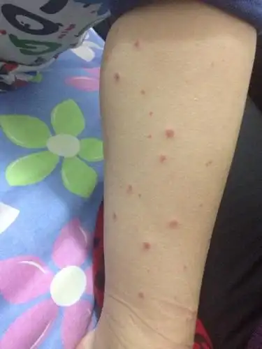 我儿子8岁,突患紫癜,肚子疼了一天了.双脚,小腿布满红色出血点.