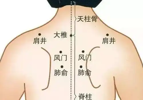哮喘拔罐示意图 哮喘患者在饮食上有哪些宜忌