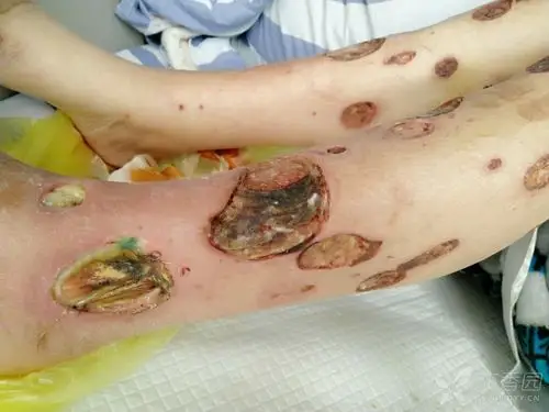 中年女性,糖尿病基础,全身皮肤破溃原因不明