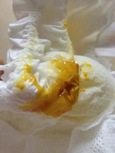 十二天的女宝宝,大便粘稠,金黄色,像蜂蜜浆一样,有图,麻烦看一下怎么