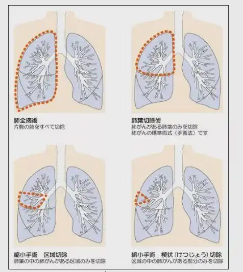 切多少怎么切肺癌手术怎么做治疗效果能达到最好一文了解