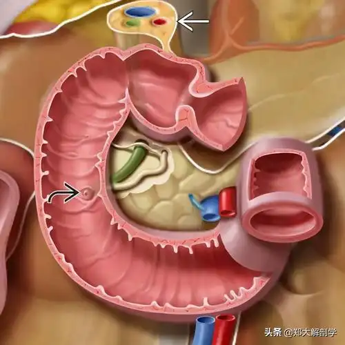 十二指肠息肉(十二指肠息肉是怎么回事)