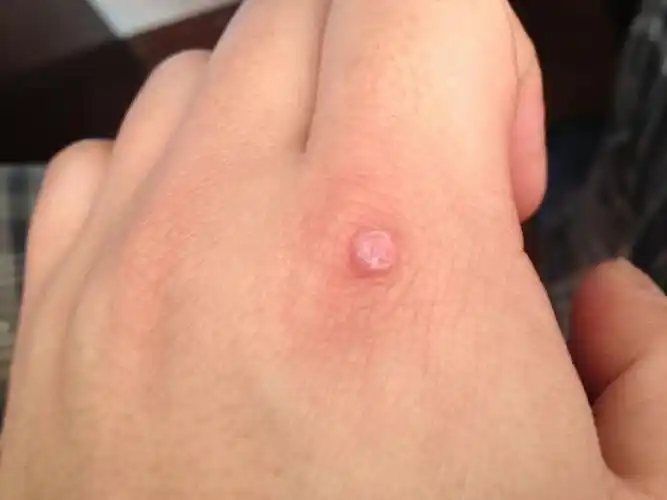 瘊子怎么治疗能除根(小心脸上手上的凸疣)