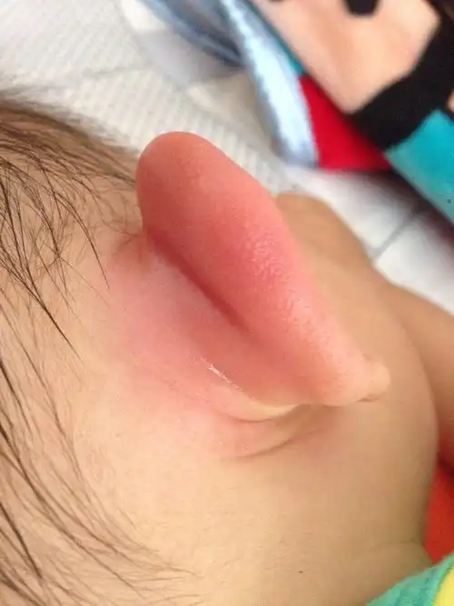 宝宝耳朵被蚊子咬了又红又肿怎么办?