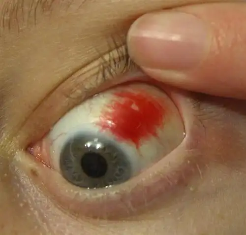 白睛溢血