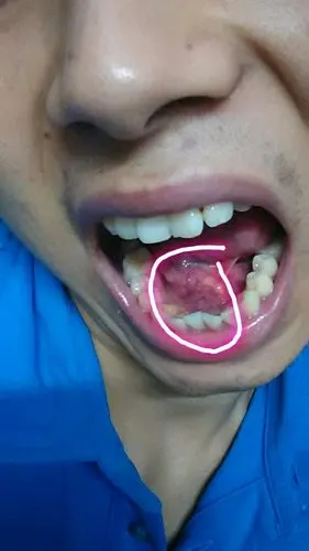 舌系带长了个水泡,我图中标记的那块肉吃饭的时候