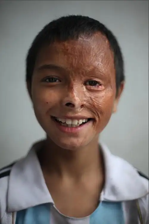 聚焦尼泊尔惨重烧伤儿童(组图)