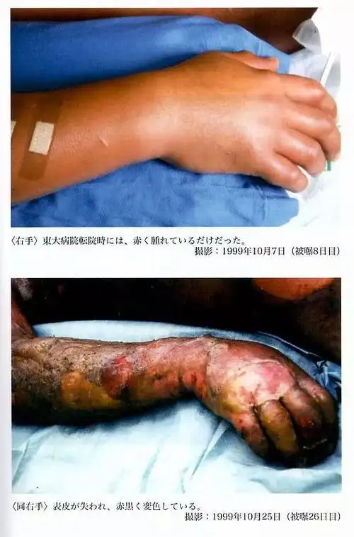 东海村核事故亲历者大内久每天目睹身体腐烂