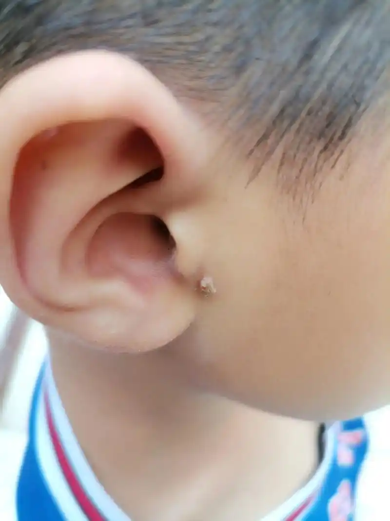 去除瘊子的最佳植物,之前花五百多也没出去掉也没少