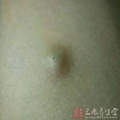 脂肪瘤 如何治疗脂肪瘤