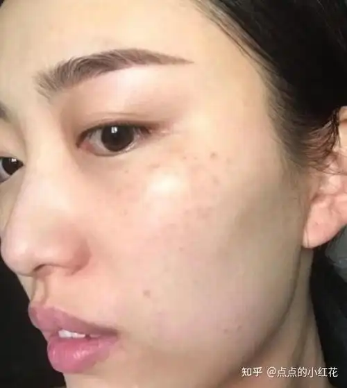 黄褐斑一个月亲测实录