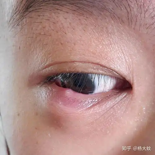 麦粒肿 - 知乎