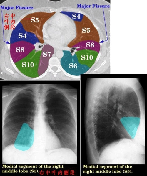 影像学肺叶分段