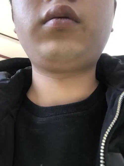 我这是淋巴结肿大么