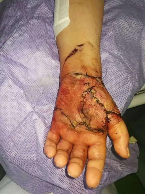 左手压面机伤(副本)