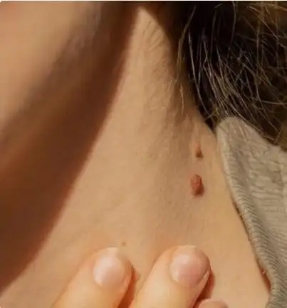 丝状疣或扁平疣.