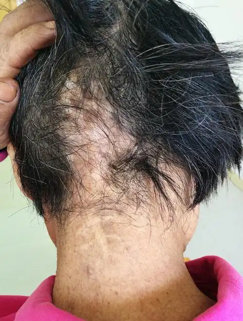 一例巨大头皮肿瘤的手术治疗_黑色素瘤 - 好大夫在线