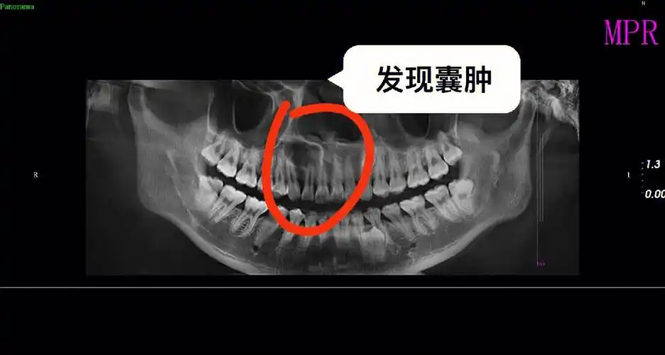 有根尖囊肿[二r]阶段二:回家直接做手术[三r]阶段三:一年后口腔检查