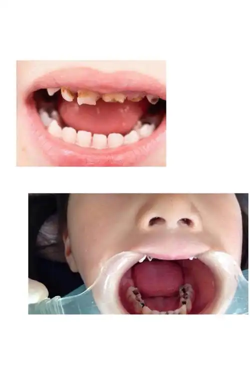 幼儿牙齿保健小常识 - 美篇