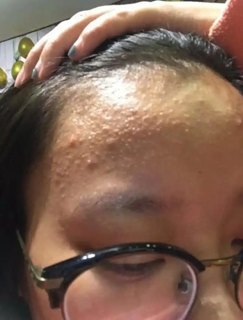 我为痘痘脸,激素脸,过敏脸,皮肤瘙痒,荨麻疹,湿疹等皮肤问题 - 抖音