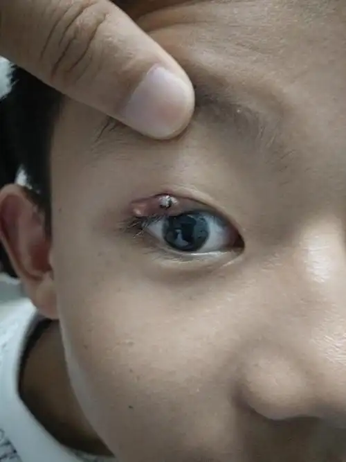 睑腺炎(俗称:麦粒肿,中医名:针眼)的个人经验治疗