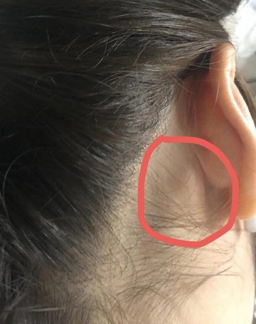 3,当细菌,病毒等进入淋巴结后,引起体液免疫应答,淋巴结为了多产生