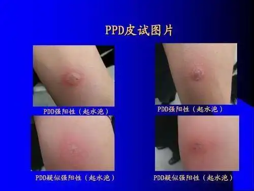 ppd筛查有什么作用?ppd阳性,强阳性是不是说明患了肺结核?