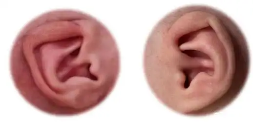 每两个孩子就有1个耳廓畸形