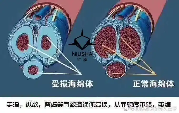 一旦频繁手淫,阴茎海绵体受损,是不能自己修复的,受损不仅导致时间变