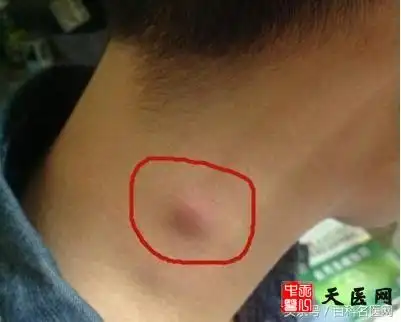 颈部淋巴结肿大不可大意,出现这些症状要警惕淋巴癌!