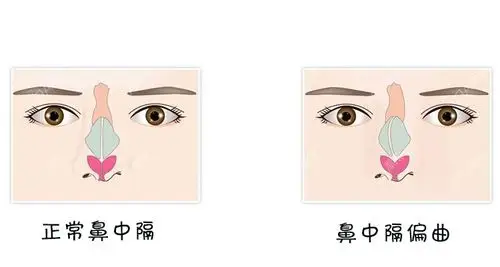 清华大学中西医结合医院鼻科专家申力什么是鼻中隔偏曲