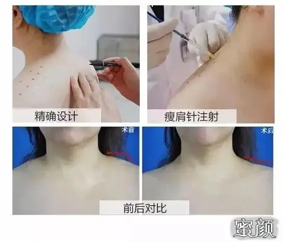 肉毒素注射后,多久起效?