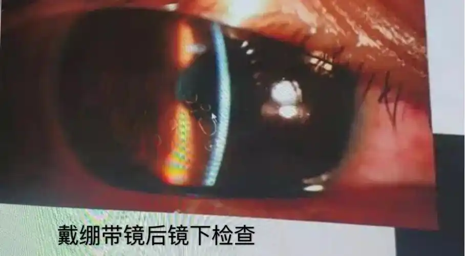 花汁有毒溅入眼睛 角膜绷带镜帮大忙