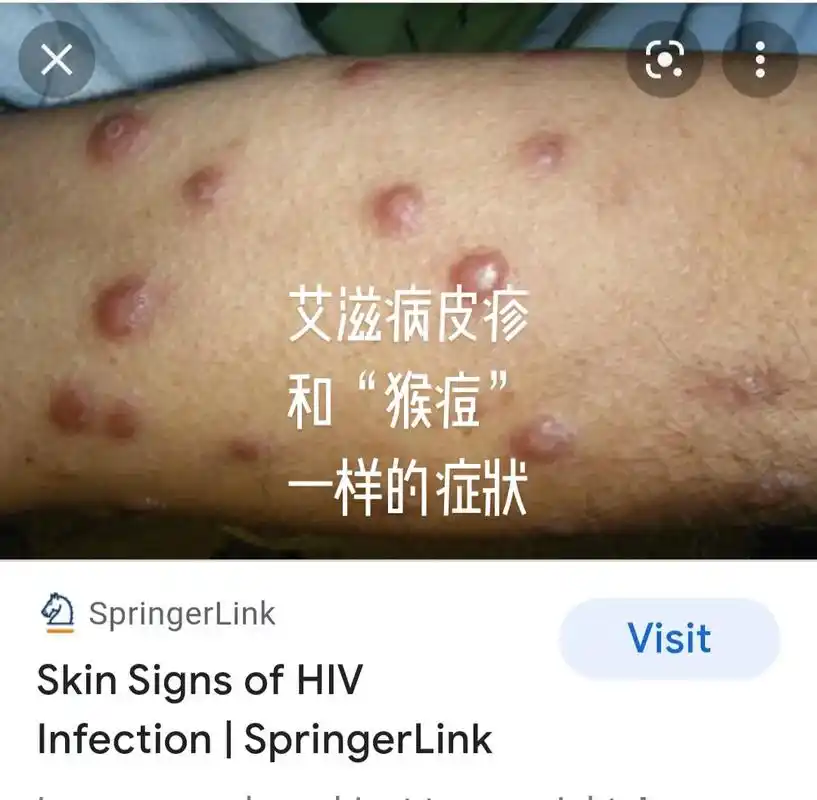 常识分享——艾滋病皮疹.