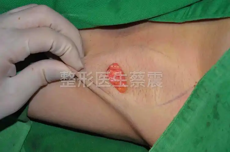 图解腋臭(臭汗症)的整形外科微创手术治疗_蔡震_主任医师_爱问健康