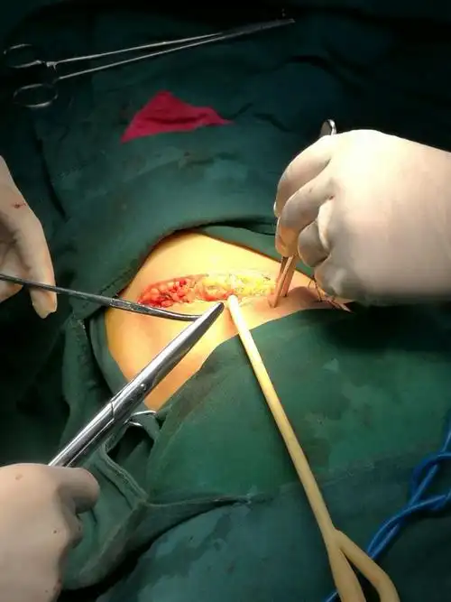 黄金医院开展了肾盂切开取石术