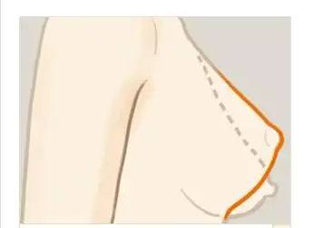 乳房下垂矫正我们应该注意事项是什么