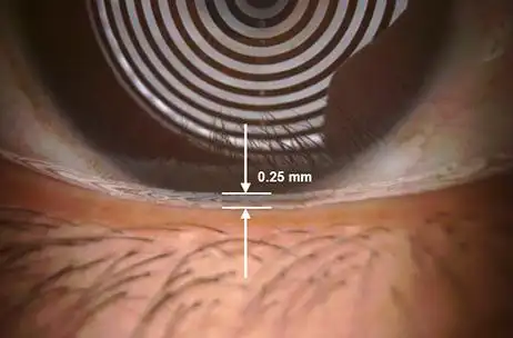 泪河高度 tear meniscus height