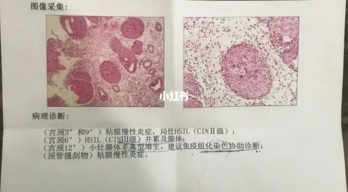 记录:宫颈原位腺癌和癌前病变(二)