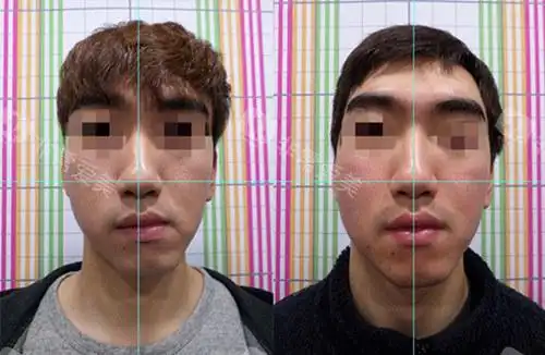 韩国美尔韩医院面部不对称脸歪矫正后记分享,术后好多了