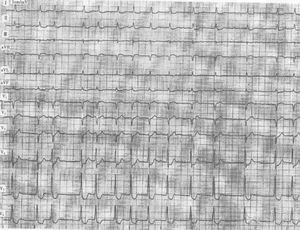 一例典型的洋地黄型 st 鱼钩样改变