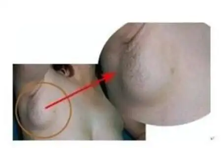 艾滋病潜伏期症状三:淋巴结肿大