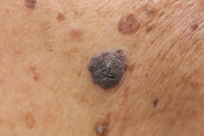 肿瘤|脓包|色素痣_网易订阅