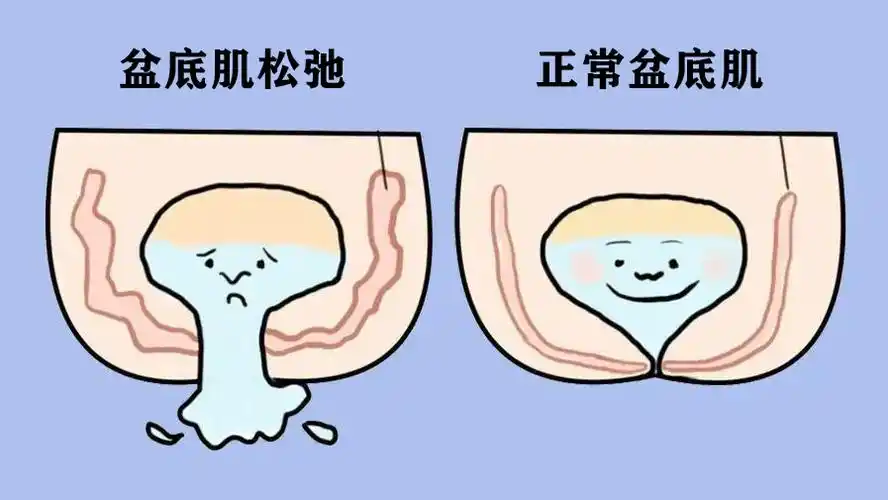 科普世界尿失禁周将至丨90产后妈妈都会中招的难言之隐