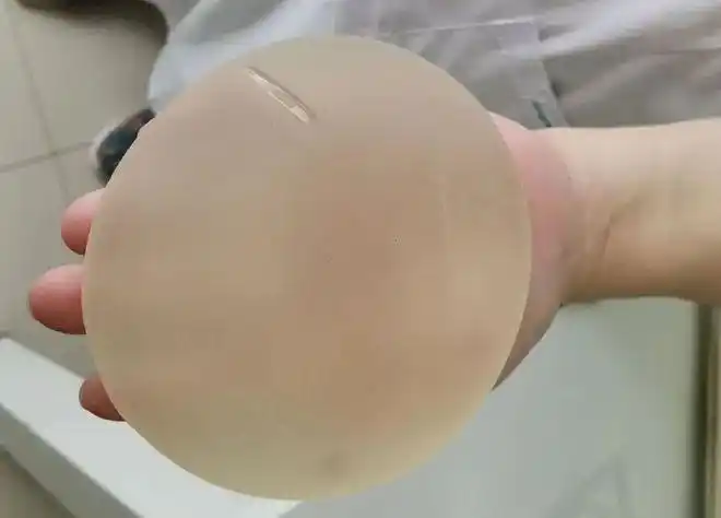 渭南市妇幼保健院乳腺科成功开展首例乳房重建术|手术|假体植入|肿瘤