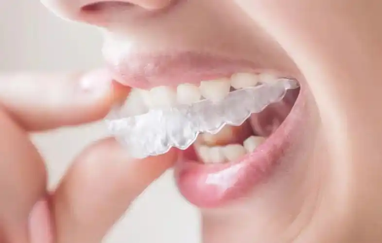 隐适美矫正丨正畸过程也要美美哒