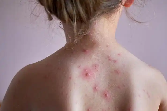 儿童水痘初期水疱图